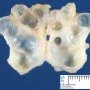 Popliteal synovial cyst