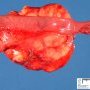 Mesenteric lipoma