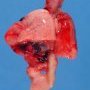 Esophageal atresia with tracheoesophageal fistula