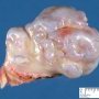 Osteochondroma