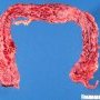 Diffuse colitis