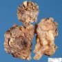 Plexiform neurofibroma in neurofibromatosis type 1 (NF1)