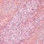 Monophasic synovial sarcoma with t(X;18)