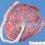 Normal placenta