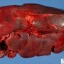 Congestive spleen in spherocytosis