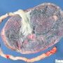 Long insertion of the umbilical cord (34 weeks)