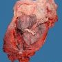 Placenta percreta (08)