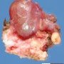 Cyst of the thyroglossal tract