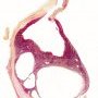 Hepatic mesothelial cysts