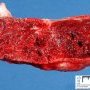 Placental intervillous thrombus