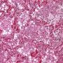 Acute pneumonia in bacterial pneumonia
