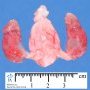 Short ureters with megacystis