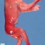 Acrania in anencephaly (21 weeks)