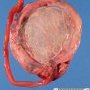 Circumvallate placenta