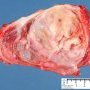 Ovarian hemorrhagic serous cystadenoma