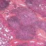 Pulmonary nodular lymphoid hyperplasia