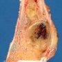 Distal tibial osteosarcoma