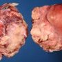 Uterine leiomyosarcoma