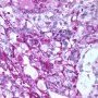 Yolk sac tumor