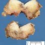 Pilonidal sinus cyst
