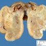 Nasal inflammatory pseudopolyp