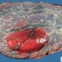 Subchorial hematoma