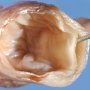 Ileal duplication cyst