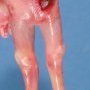 Anal imperforation, stiff and amyotrophic lower limbs