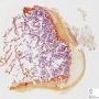 Osteochondroma