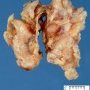 Plexiform neurofibroma in neurofibromatosis type 1 (NF1)