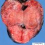Acute orchitis