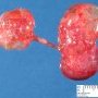Ureteral fusion with vesical agenesis (sirenomelia)