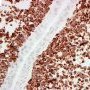 Embryonal botryoid rhabdomyosarcoma of the rhinopharynx (desmin)