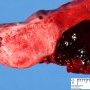 A frequent cause of fetal death: retroplacental hematoma