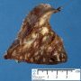 Bronchiectasis and BALT hyperplasia (Case 11750)