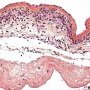 Acute chorioamnionitis