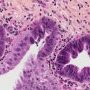 Biliary epithelial dysplasia in choledochal cyst