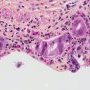 Biliary epithelial dysplasia in choledochal cyst