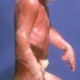 Pfeiffer syndrome