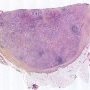 Nodal cryptococcosis (Cryptococcus neoformans)