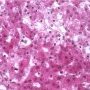 Minocycline-induced hepatitis
