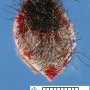 Nodular melanoma of the scalp