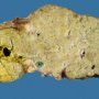 Cystic dilatation of a main bile duct in extrahepatic biliary tract (...)