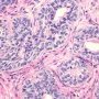 Basal Cell Hyperplasia in Prostate