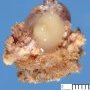 Cyst of the thyroglossal tract