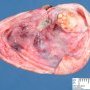 Ovarian serous cystadenoma