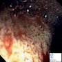 Chylomicron retention disease (Duodenal endoscopy)
