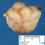 Mammary fibroadenoma