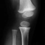 Metaphyseal fibrous defect