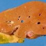 Hepatic steatosis